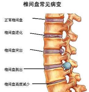 椎间盘突出的常见病因是什么?