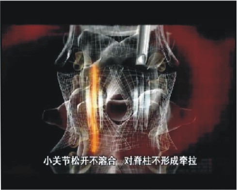 西华骨科医院,独特的“段层套管技术”疗法