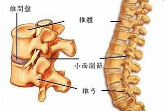 腰椎间盘突出