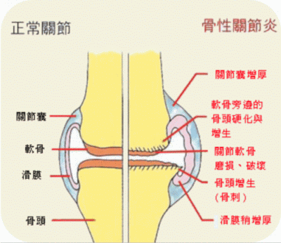 关节炎