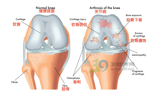 骨性关节炎的三大危害